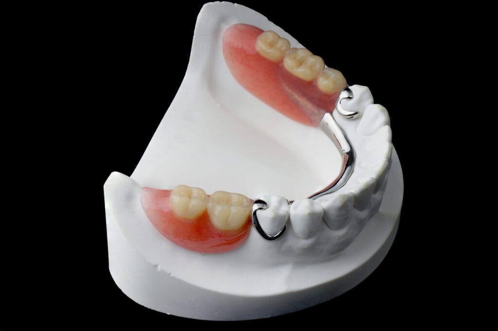 fixed partial dentures