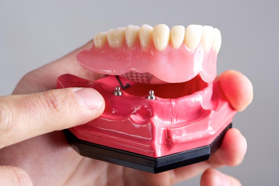 implant dentures