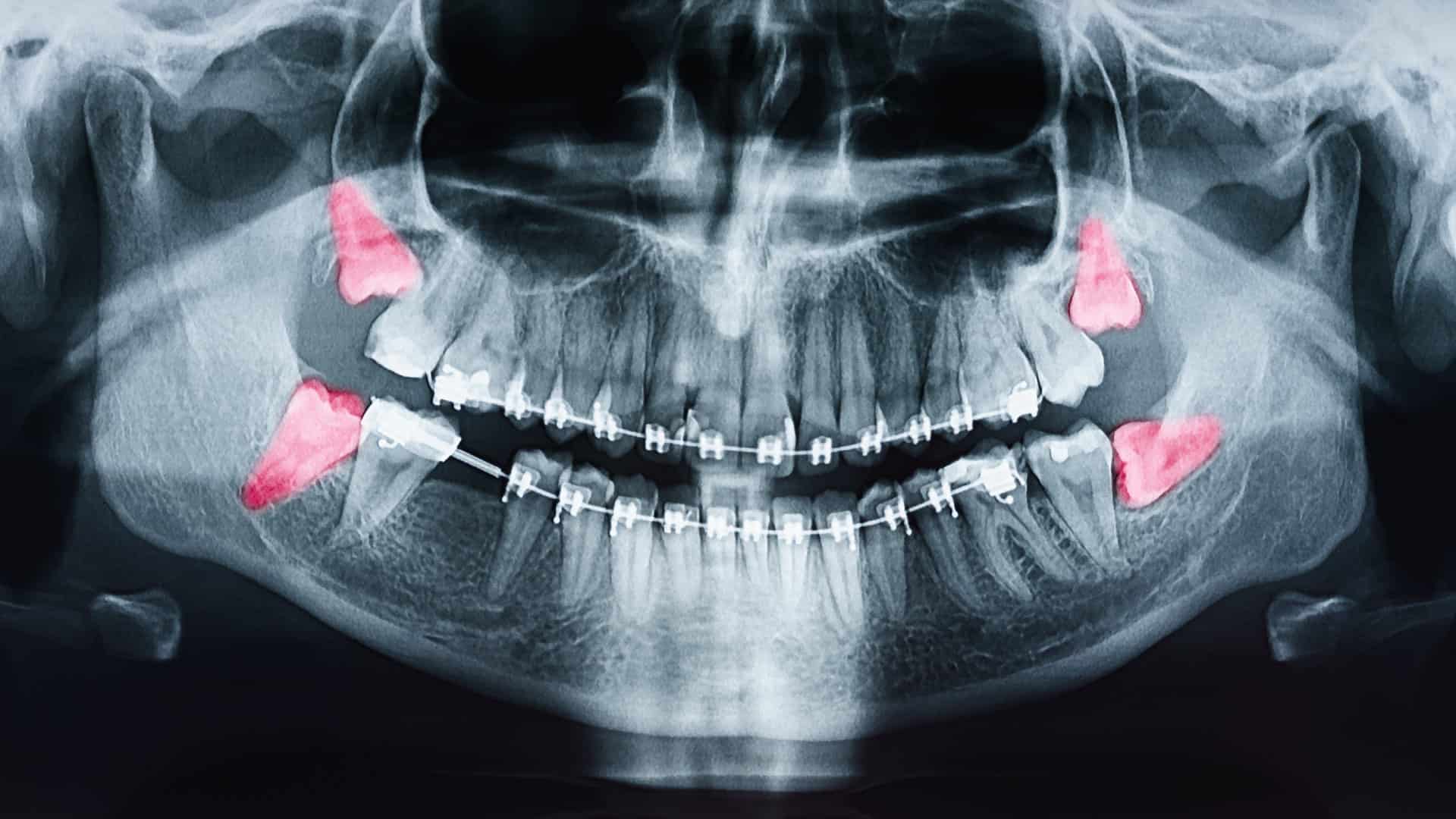 wisdom tooth extraction x-ray
