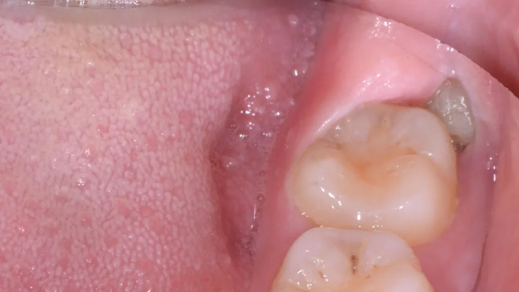 Wisdom tooth growing pain how long