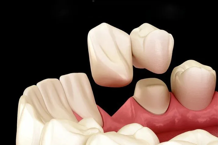 Cantilever bridge dental