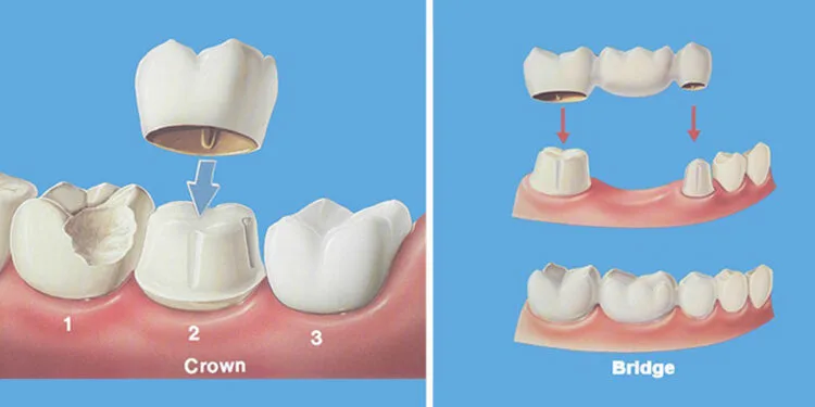 Dental crowns vs bridges 1 750x375