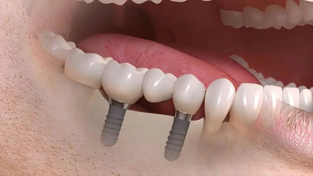 Implant supported bridgework image