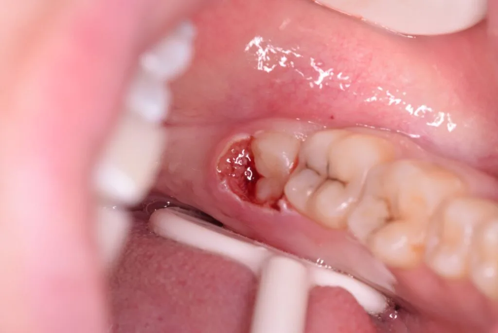 Operculectomy after