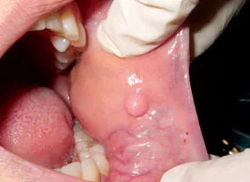 Excisional biopsy