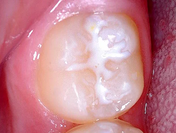Fissure sealant