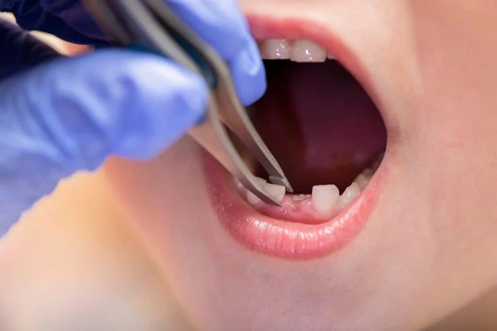 Baby tooth extraction