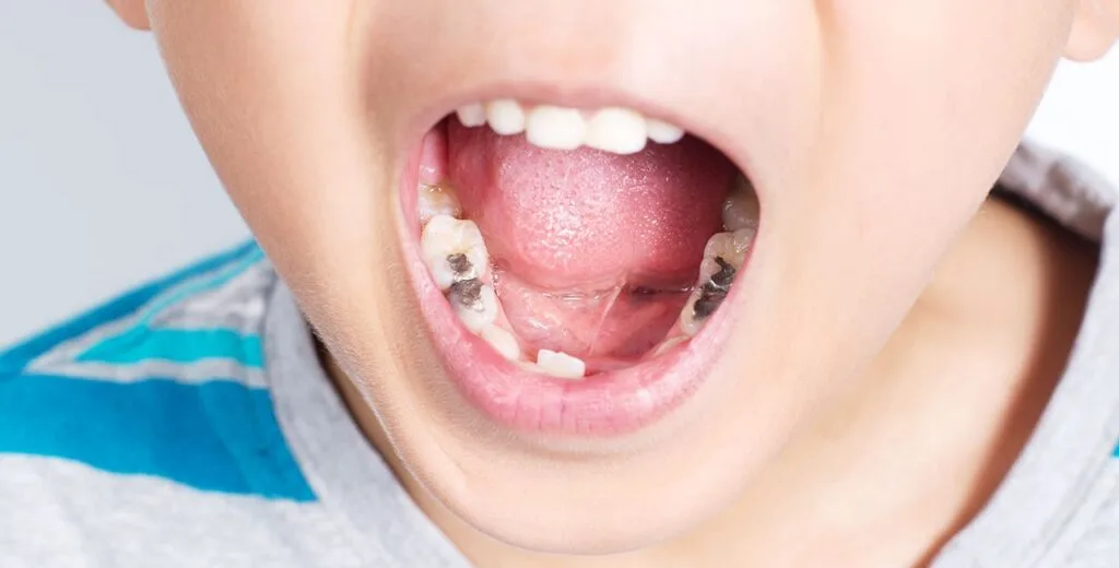 Dental fillings