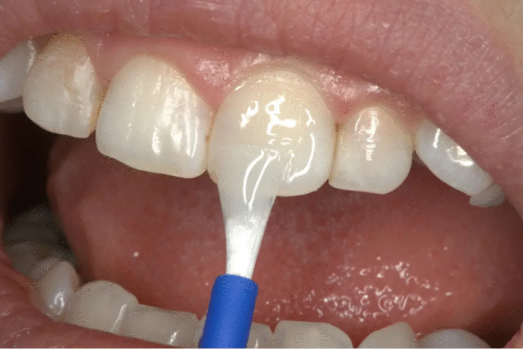 Fluoride treatment benefits