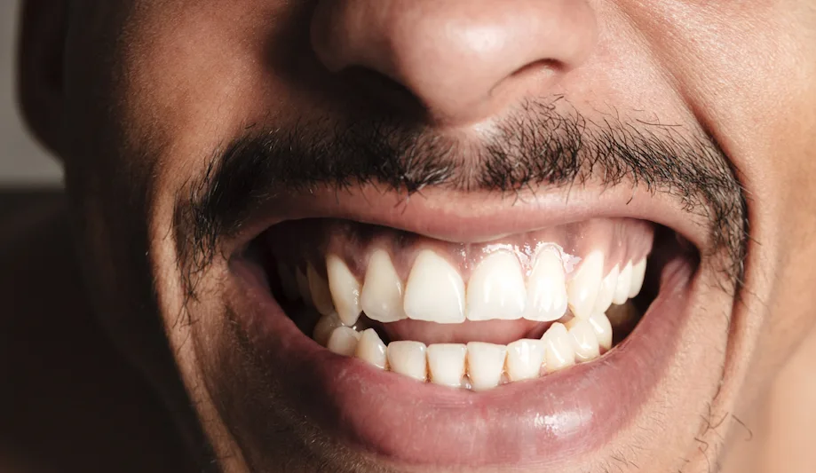 Open bite