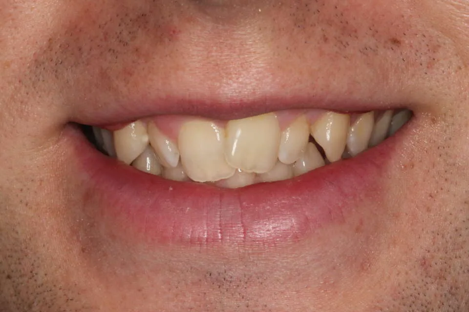 Rotated teeth